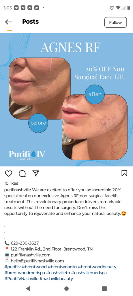 Instagram Post for Med Spa Social Media Marketing Microneedling