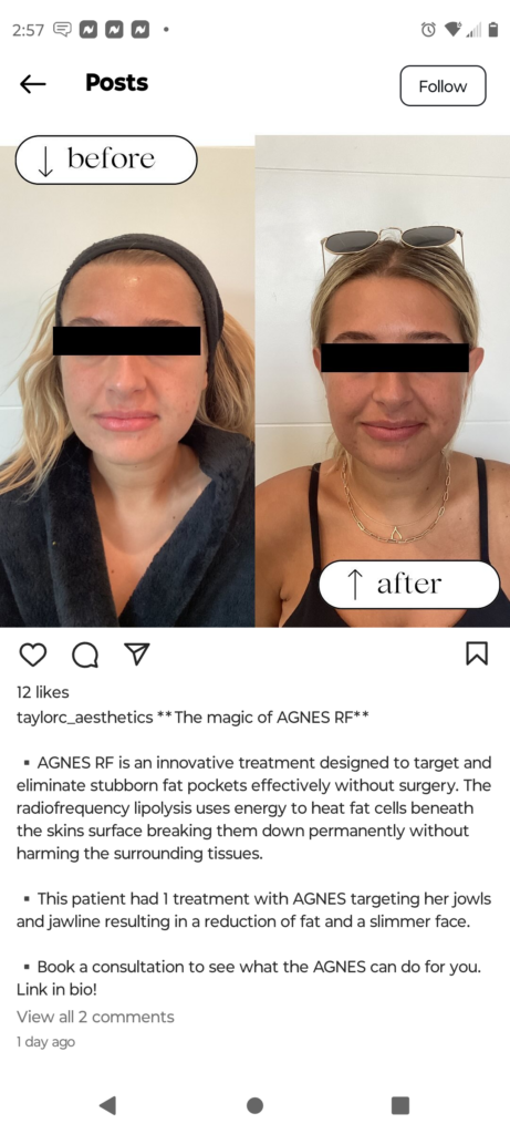 Before and After Photos Med Spa Social Media Marketing